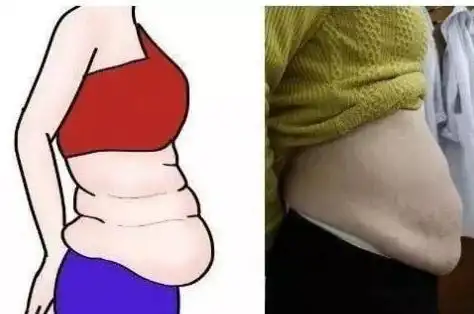 产后腹部松弛多肉能通过水动力分层吸脂吗