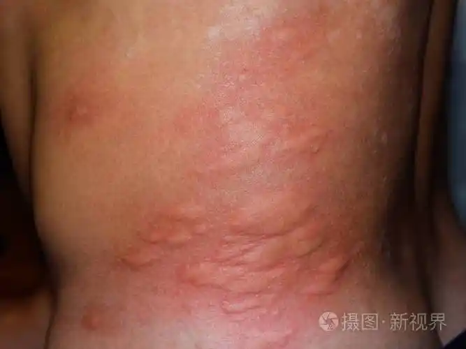 背部和两侧皮肤过敏皮肤上的过敏反应表现为肿胀和发红