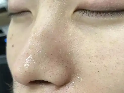 黑头粉刺图片(毛孔粗大还有黑头这不是要人命吗) - 赤虎壹号