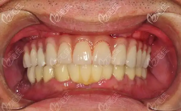 瑞典astra和瑞士iti种植牙有什么区别哪个更好呢