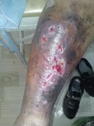 18天治愈老烂腿 - 中医皮肤版 - 爱爱医医学论坛 - 爱爱医医学网