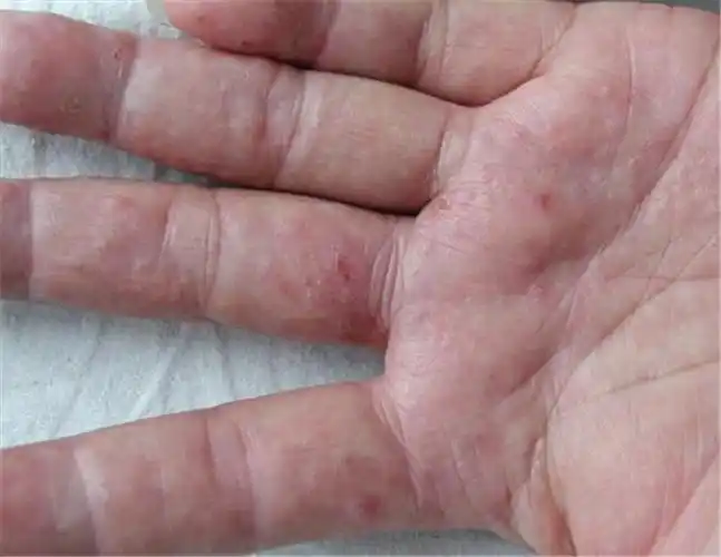 湿疹手癣症状图片_有来医生