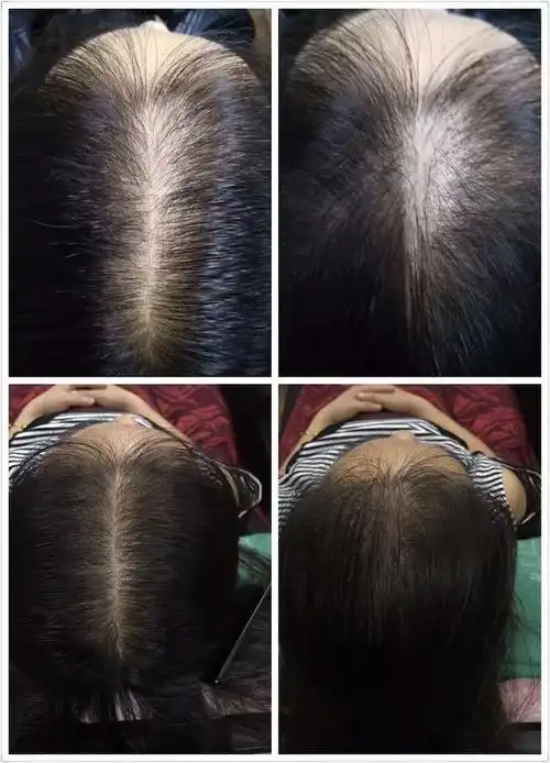 治疗白发,脱发,遗传性白发,斑秃.咨询电话:18839492306