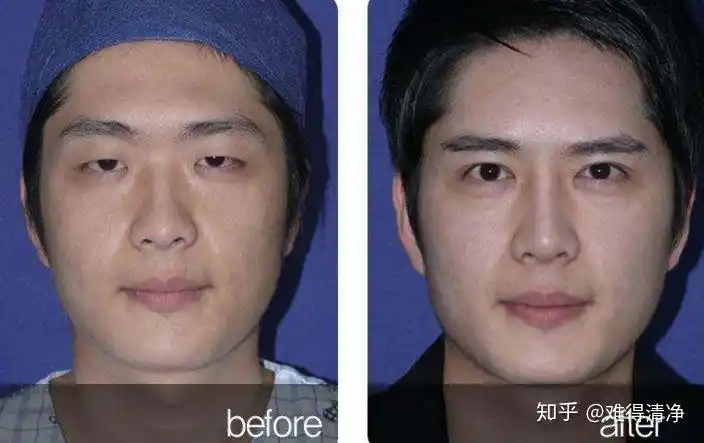 如何看待男生割双眼皮?