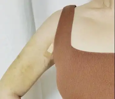 手臂吸脂后皮肤明显松弛