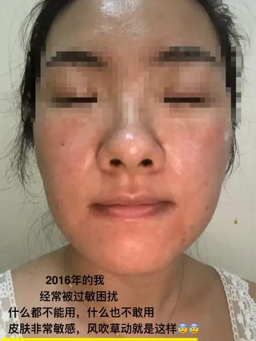 皮肤屏障受损有什么危害?