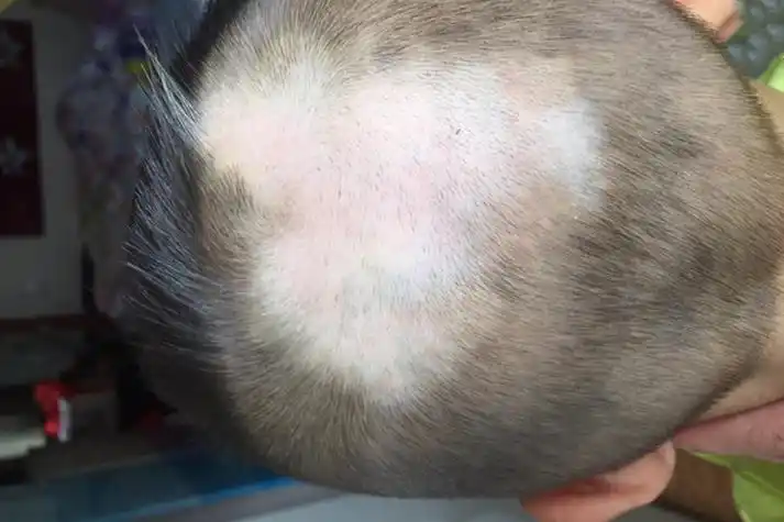 白癜风婴儿后脑勺白斑图