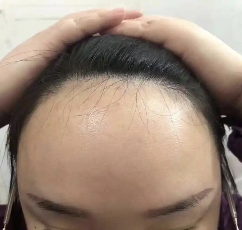 发际线太高可以植发吗