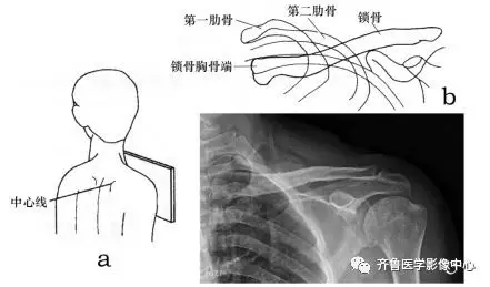 肩关节肩胛骨肩锁关节影像技师摄影方法