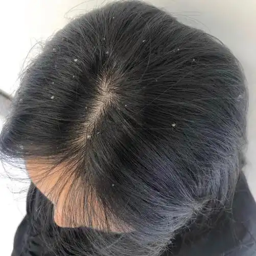 为摆脱头皮屑你做了哪些努力?三款专业去屑洗发水,告别雪花头