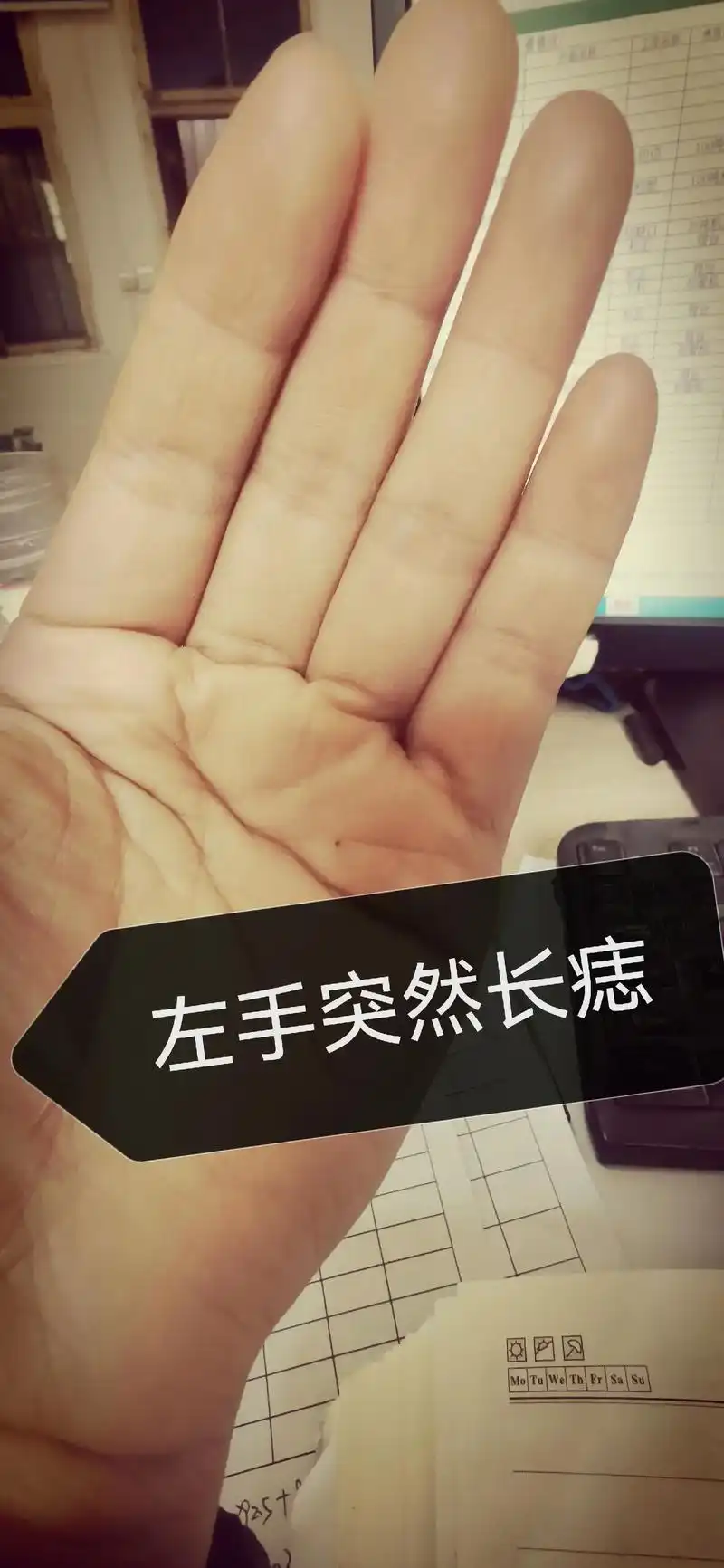 左手最近突然长痣 - 抖音