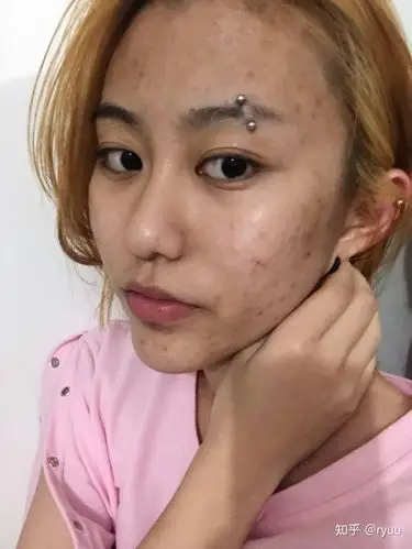 五官好看皮肤差是什么体验