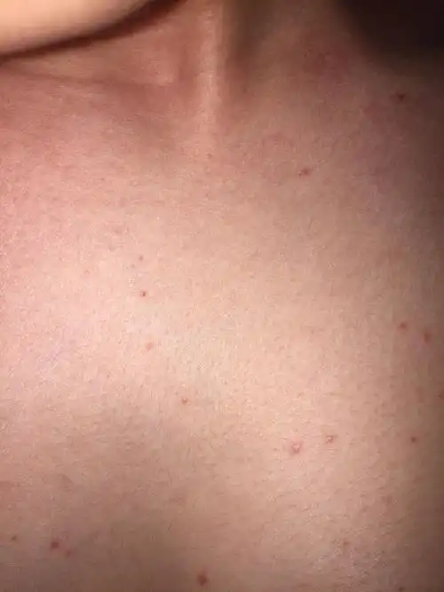 胸前出了好多小红点,之前没有出过,请问这是什么症状?