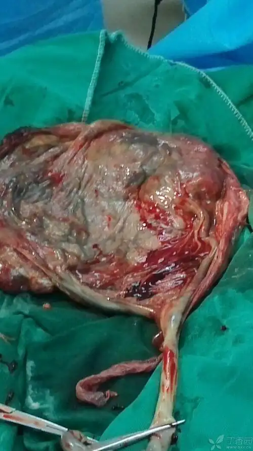 膜状胎盘还是帆状胎盘?