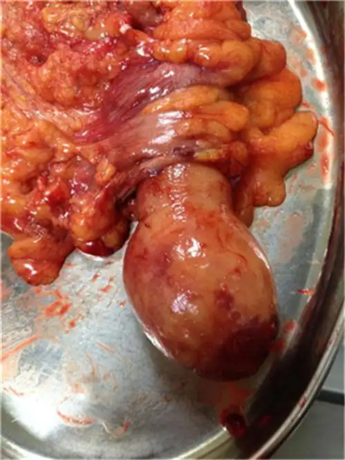 东区肿瘤专家_东区治疗肿瘤哪个专家好_东区治疗肿瘤最好的专家/排行