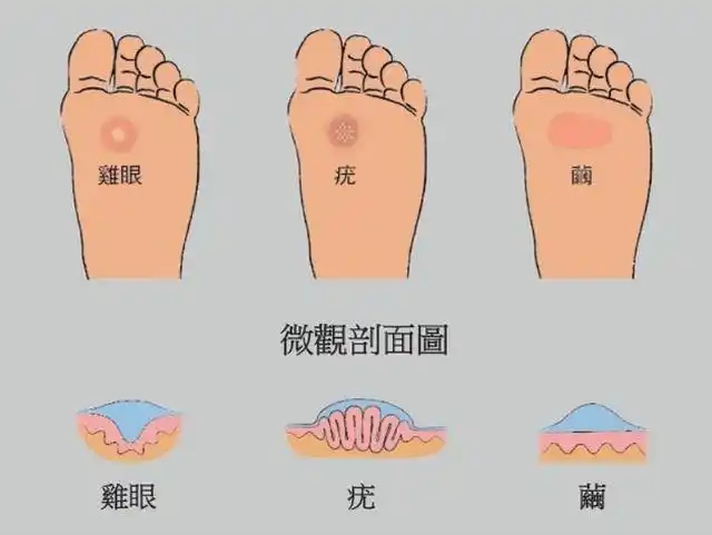 01形成鸡眼的原因主要有下面几点:1,脚上受压迫如果平时你站立的时间