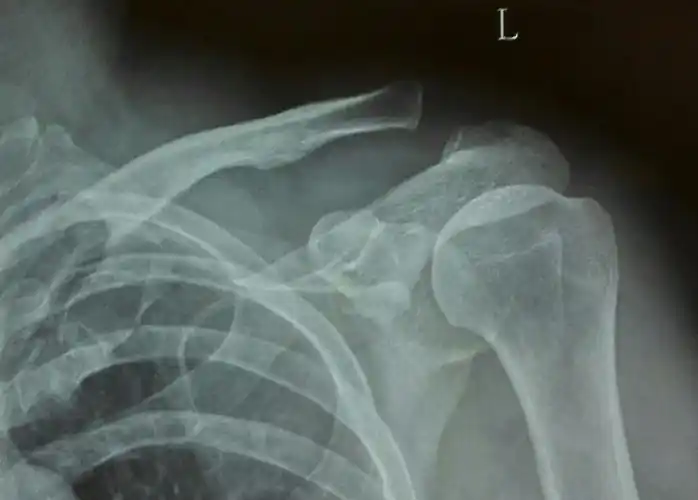 左肩锁关节脱位endbutton固定