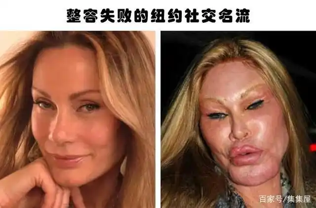 整容失败的代价:据说因为整容而毁掉了自己容貌的6个人