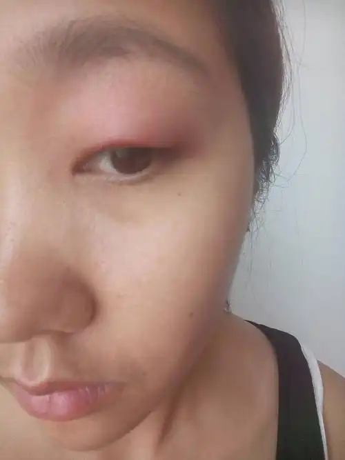 上眼皮肿起来了,不知道怎么回事就是感觉眼睛痒,然后用手揉了揉,第二