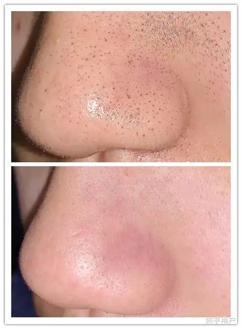 去黑头的鼻膜贴真的有用么