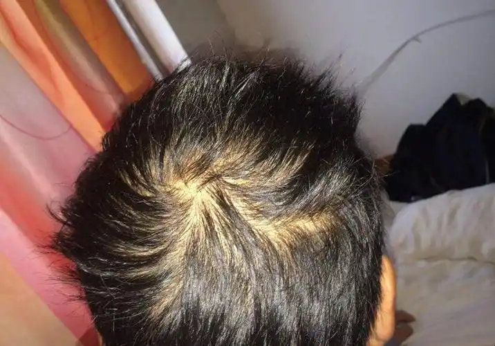 头发稀少怎么办