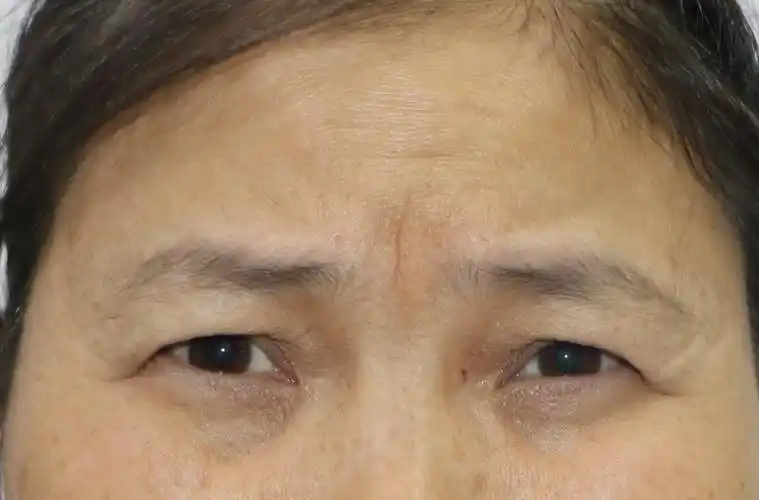 眼肌痉挛案例 - 好大夫在线