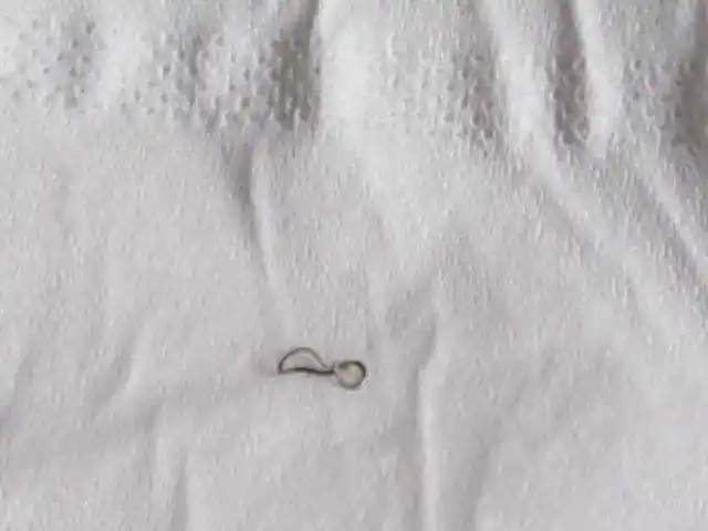 结直肠手术后吻合器的钛钉脱落是什么样的?对人体有哪些影响?