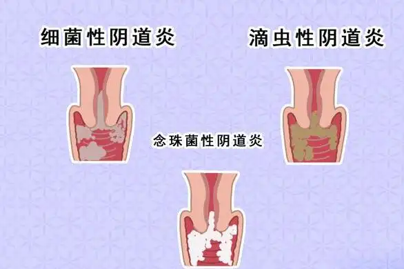 2,霉菌性阴道炎