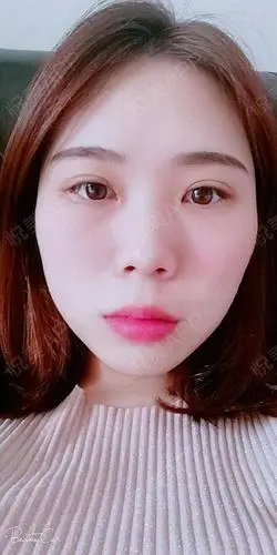 手术到现在半个月了,恢复的很好,变化真的好大啊!刚.眼综合_悦美整形