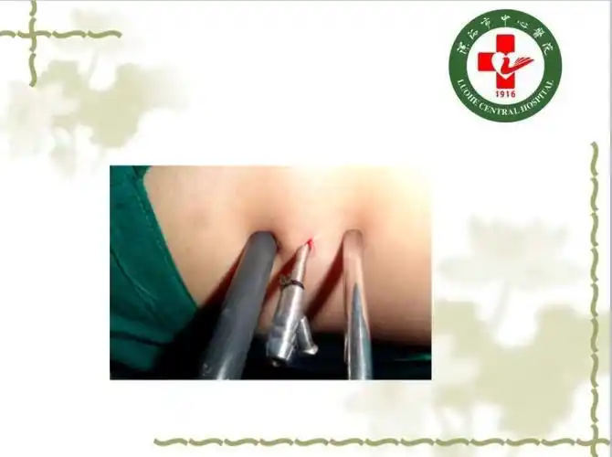 后尿道结石b型超声x线检查治疗舟状窝结石推挤或钳出前尿道结石推挤