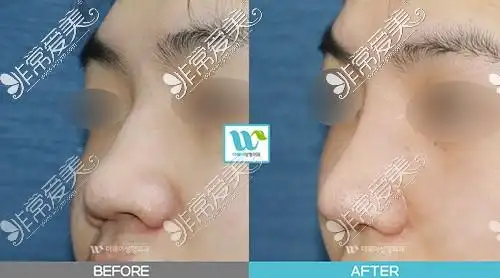 驼峰鼻矫正前后对比照片