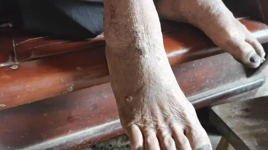 老男孩的脚不知道怎么了发有泡泡还痒,这几天都没有去工作就在家