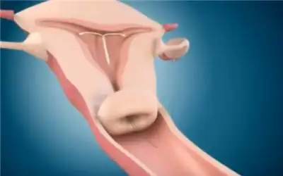 首先由医生进行消毒,然后用"送环器"将避孕环送入子宫内.