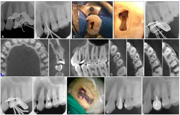 上颌第一前磨牙4根管1例