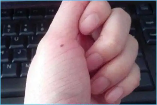 左手大拇指有痣代表什么?