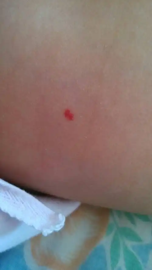 请问婴儿胸前一个小红点,像血泡,手摸有一点凸出,不疼,这是胎记吗?
