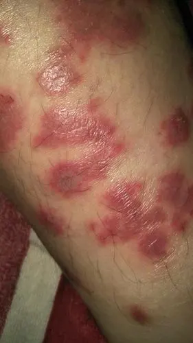 我弟身上长满了这样跟癣一样的东西好多年了去了