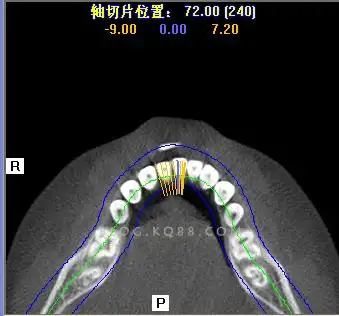上颌第一双尖牙3牙根--屈晓兵