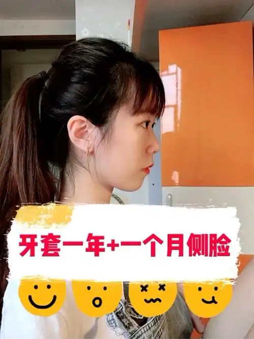 牙套一年 一个月了~侧脸变化真的超大!