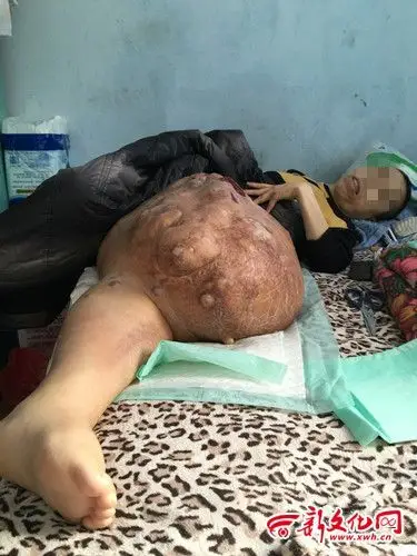 女子左腿长50斤肿瘤求治疗方法 称想看女儿高考