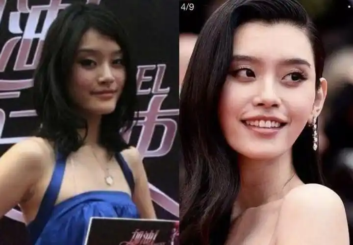 奚梦瑶垫鼻基底的假体痕迹露出来了惹