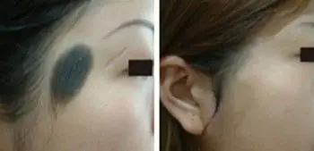 我院治疗毛痣前后对比图