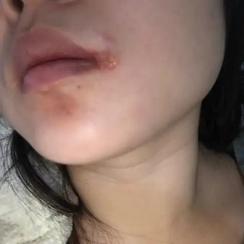 2口腔溃疡 嘴角长泡的原因也有可能是口腔溃疡所导致,而导致口腔溃疡