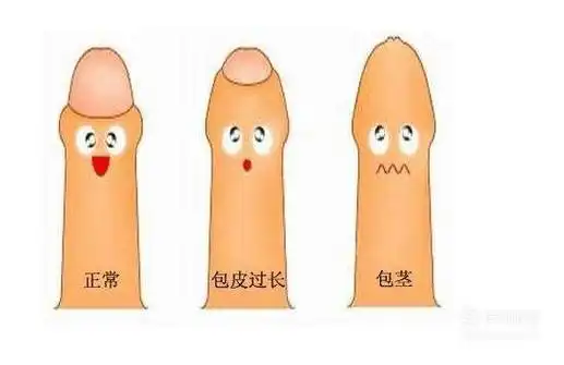 包皮过长或者包茎都需要去做手术,这样才不会影响个人生活,找正规的