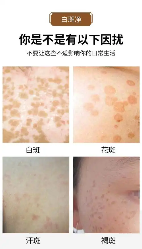 膏王爷白斑净白殿外用膏白班汗斑花斑护理膏皮肤清洁滋润一件代发