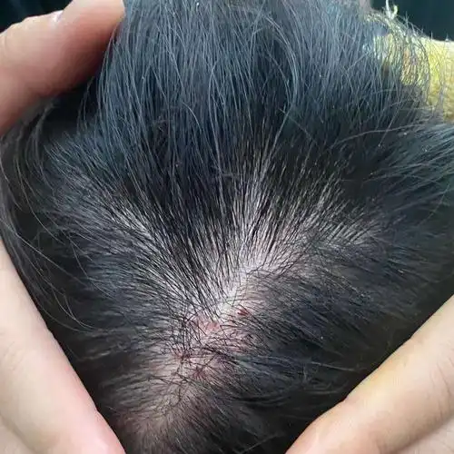 干货帖头皮长痘竟会造成脱发危机7160