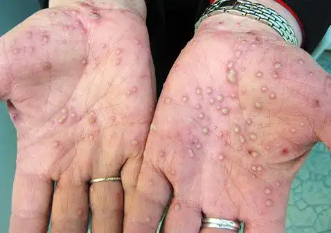 掌跖脓疱病症状图片淡黄色水泡