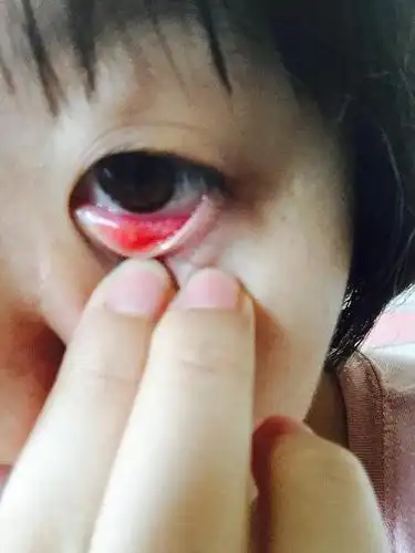 内麦粒肿,哪位大神帮我看一下.