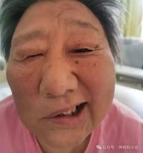 面神经炎一例 并 周围性面瘫定位诊断 及 文献复习