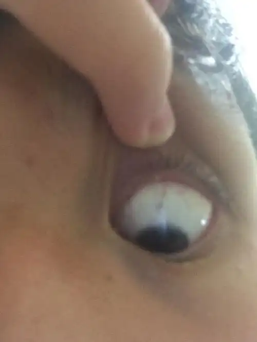 在眼睛上中间那个白色的豆豆.怎么回事?解决办法?引发原因?